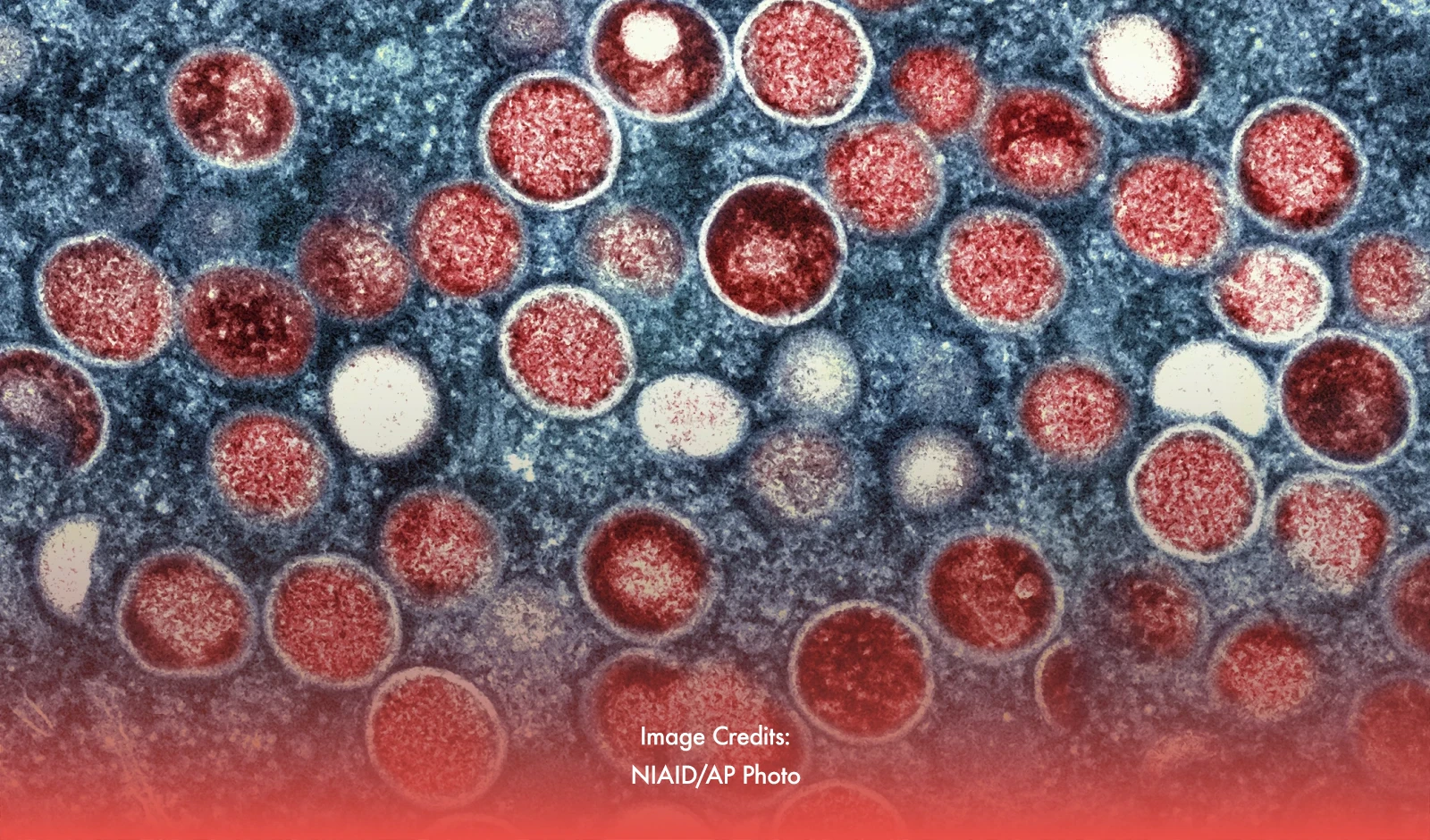 Monkeypox Now A Global Health Emergency - WHO